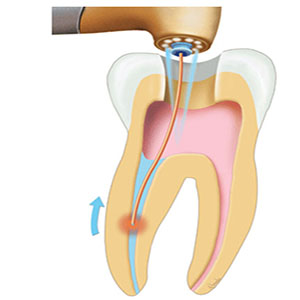 Laser Assisted Root Canal Therapy