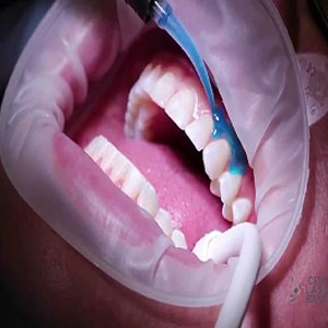 Laser Assisted teeth Whitening