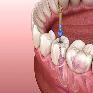 Single/Multiple Sitting Root Canal Treatment