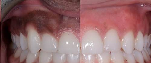 precision-dental-and-implant-Centre-51