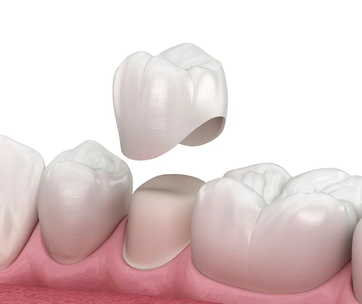 precision-dental-and-implant-Centre-24