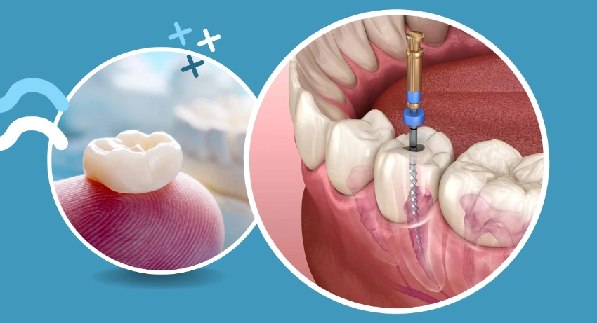 Crown after root canal protects damaged tooth