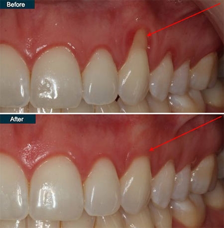 Receding gums treatment non surgical dental care