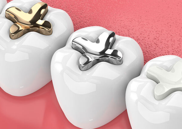 Tooth filling cost types and dental procedure India