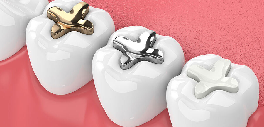 Tooth filling cost types and dental procedure India